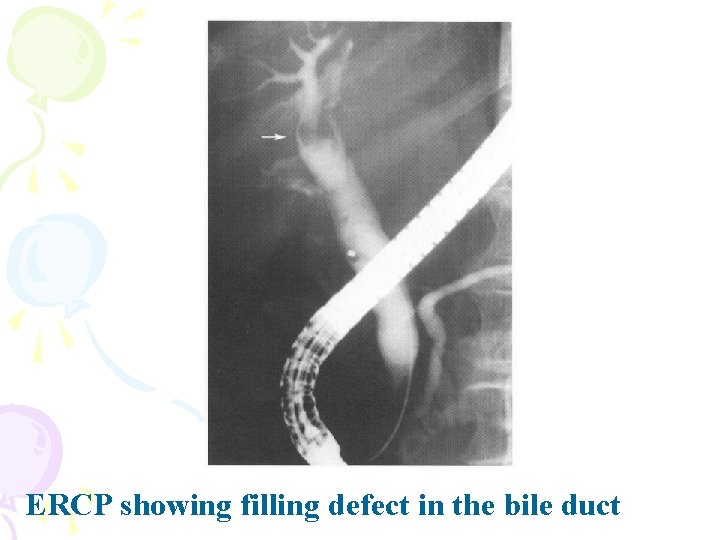 ERCP showing filling defect in the bile duct 