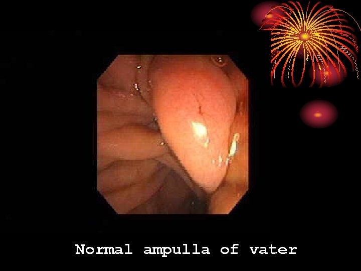 Normal ampulla of vater 
