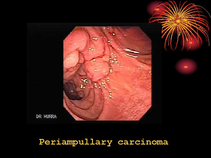 Periampullary carcinoma 
