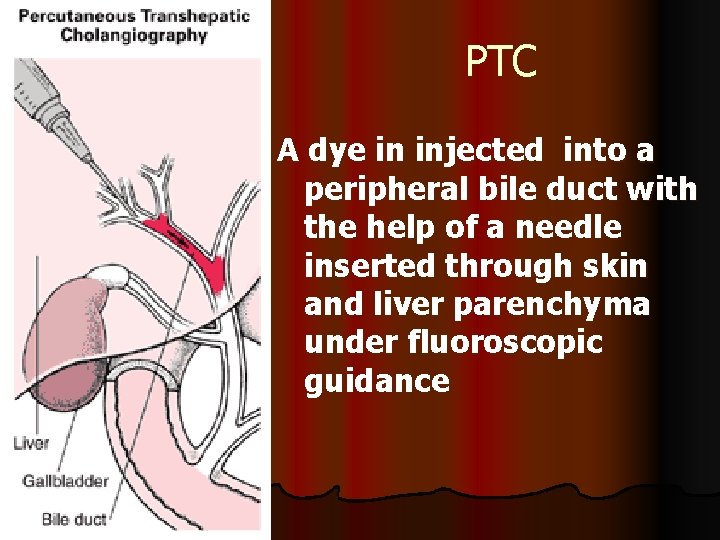 PTC A dye in injected into a peripheral bile duct with the help of