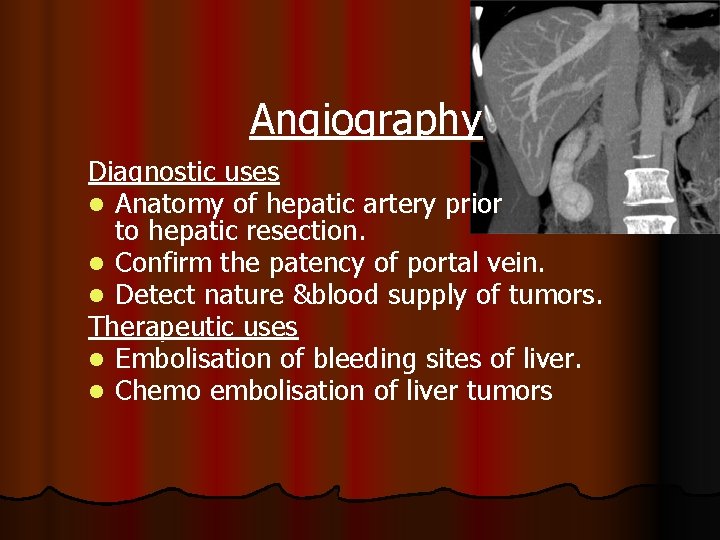 Angiography Diagnostic uses l Anatomy of hepatic artery prior to hepatic resection. l Confirm