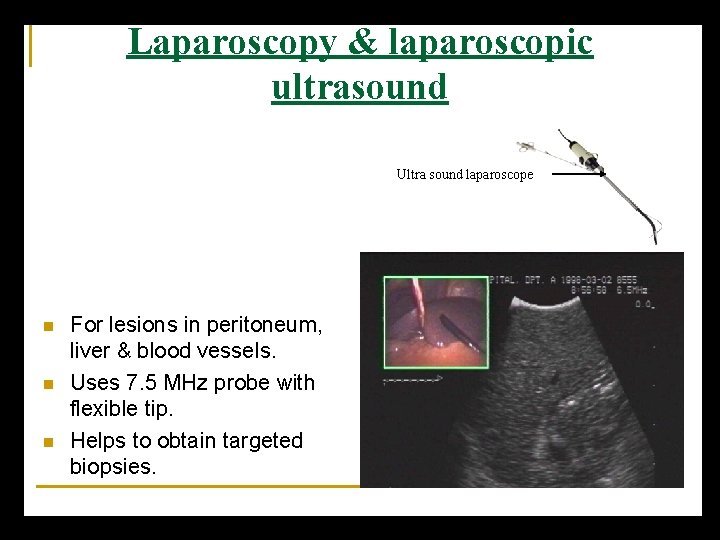 Laparoscopy & laparoscopic ultrasound Ultra sound laparoscope n n n For lesions in peritoneum,