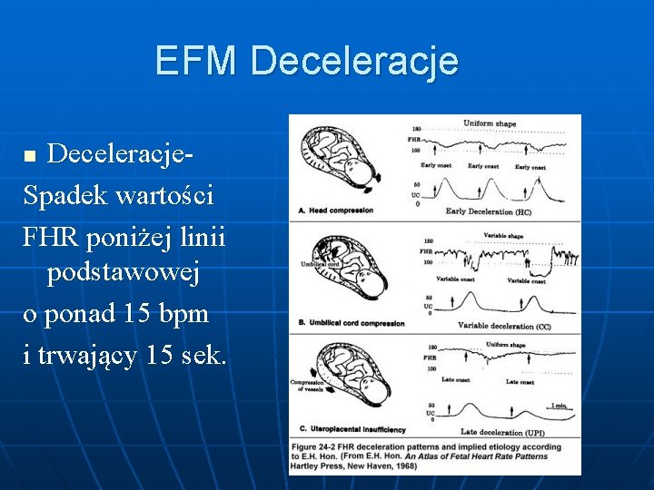 EFM Deceleracje. Spadek wartości FHR poniżej linii podstawowej o ponad 15 bpm i trwający