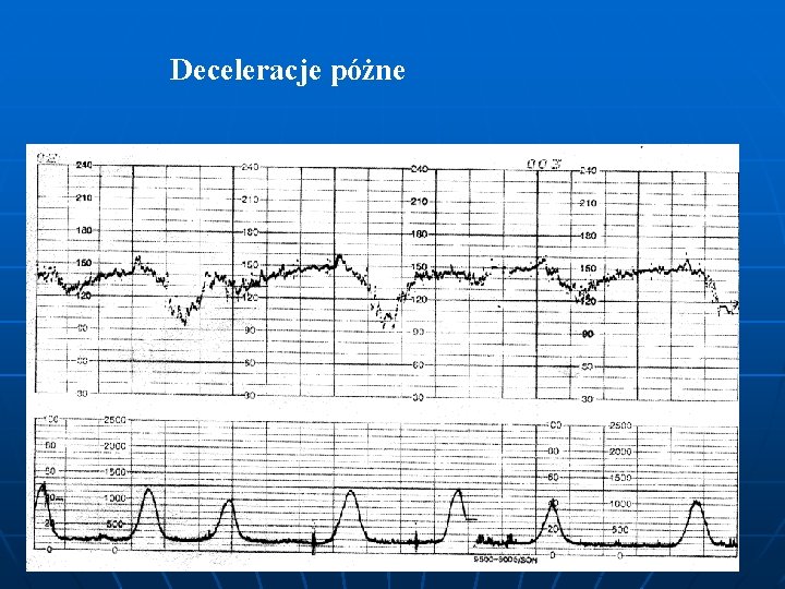 Deceleracje póżne 