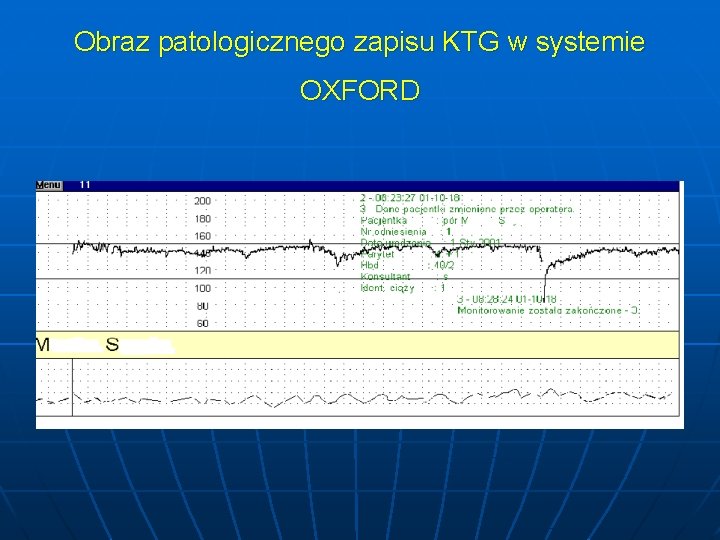 Obraz patologicznego zapisu KTG w systemie OXFORD 