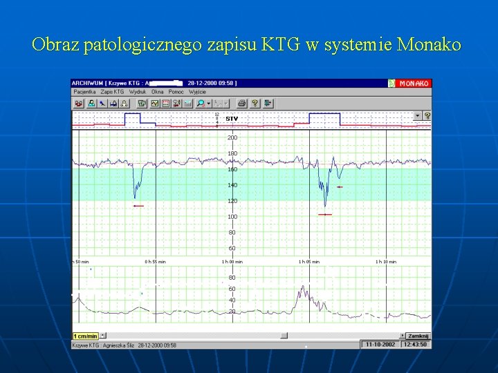 Obraz patologicznego zapisu KTG w systemie Monako 