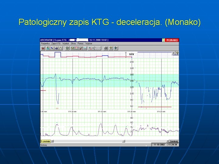 Patologiczny zapis KTG - deceleracja. (Monako) 