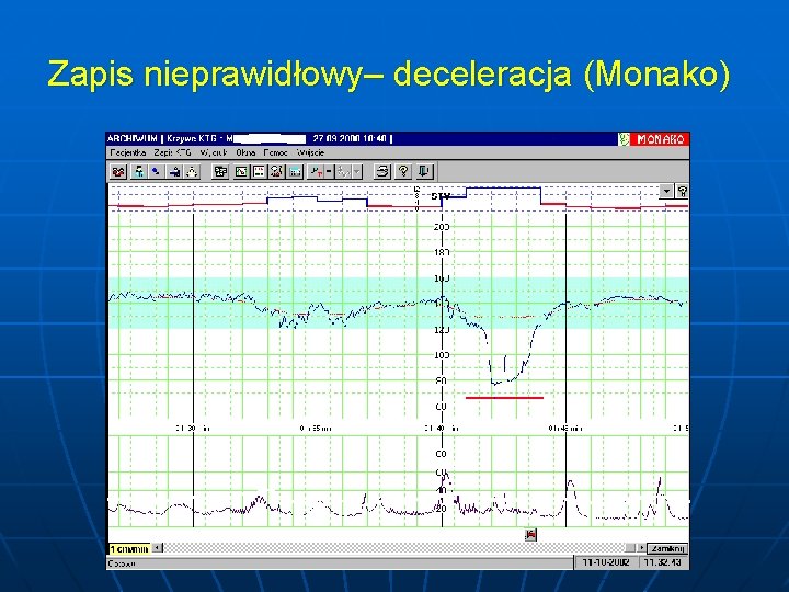 Zapis nieprawidłowy– deceleracja (Monako) 