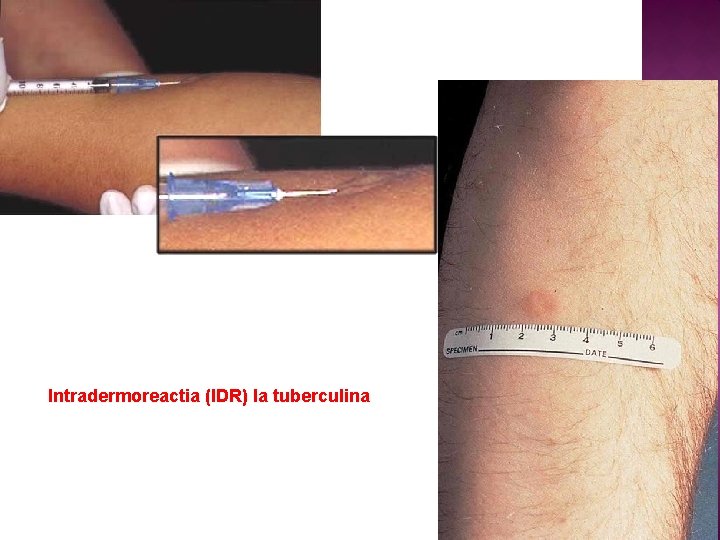 Intradermoreactia (IDR) la tuberculina 