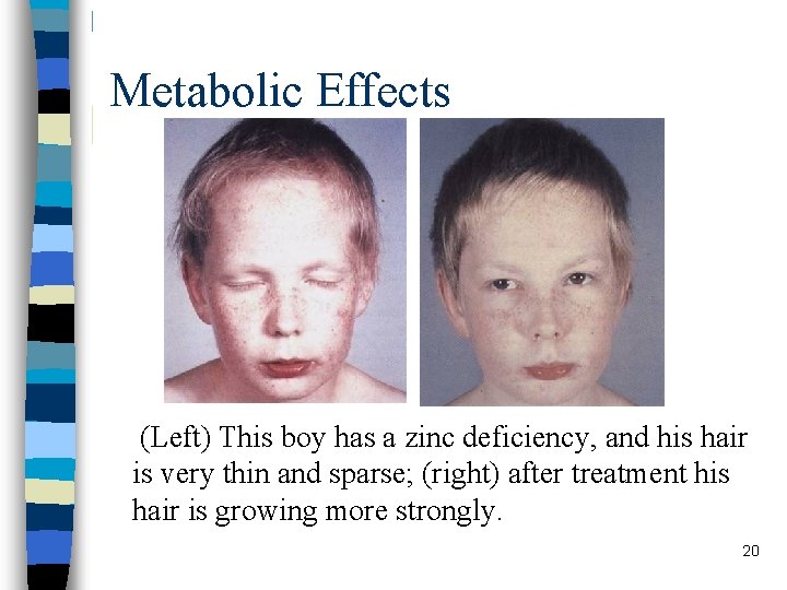 Metabolic Effects (Left) This boy has a zinc deficiency, and his hair is very Metabolic Effects (Left) This boy has a zinc deficiency, and his hair is very
