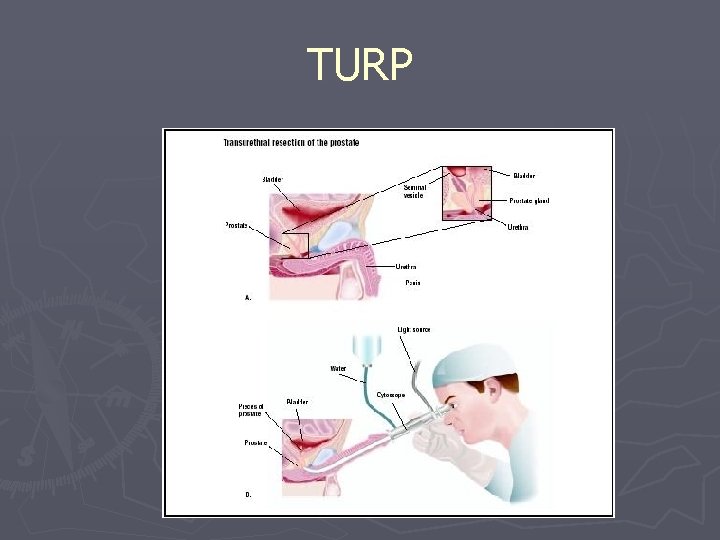 TURP 