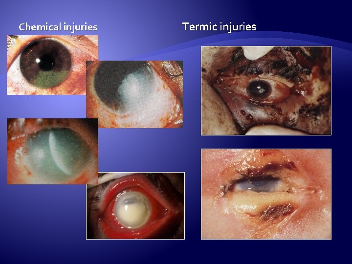 Chemical injuries Termic injuries 