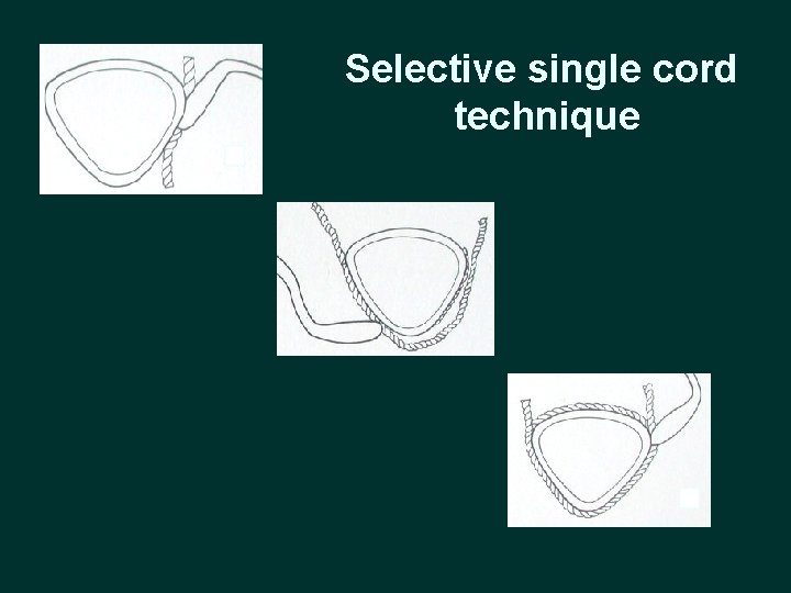Selective single cord technique 