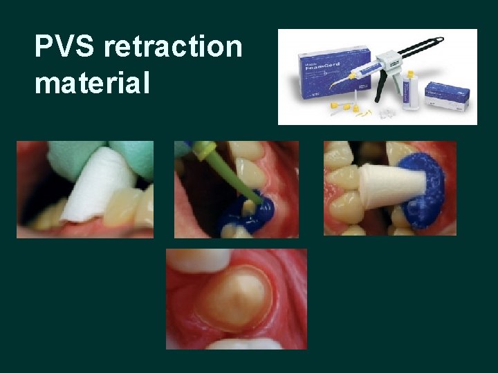 PVS retraction material 