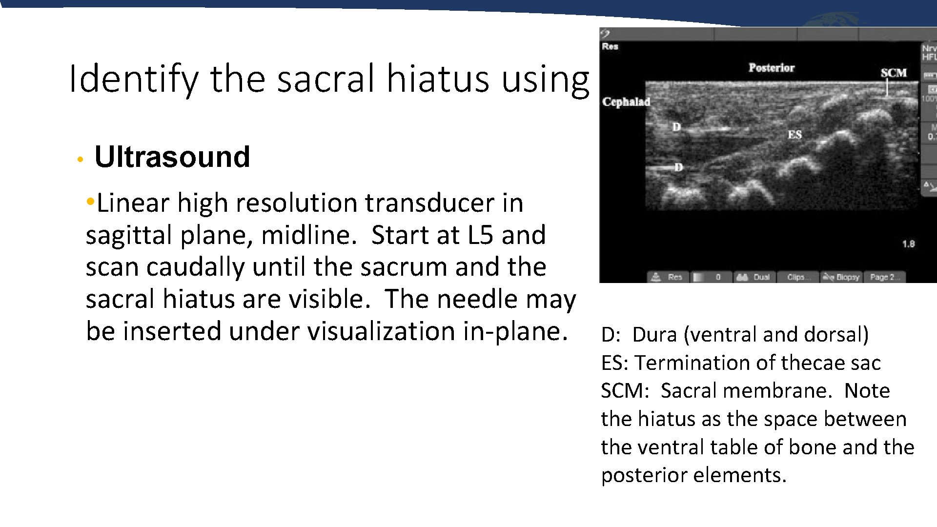 Identify the sacral hiatus using • Ultrasound • Linear high resolution transducer in sagittal