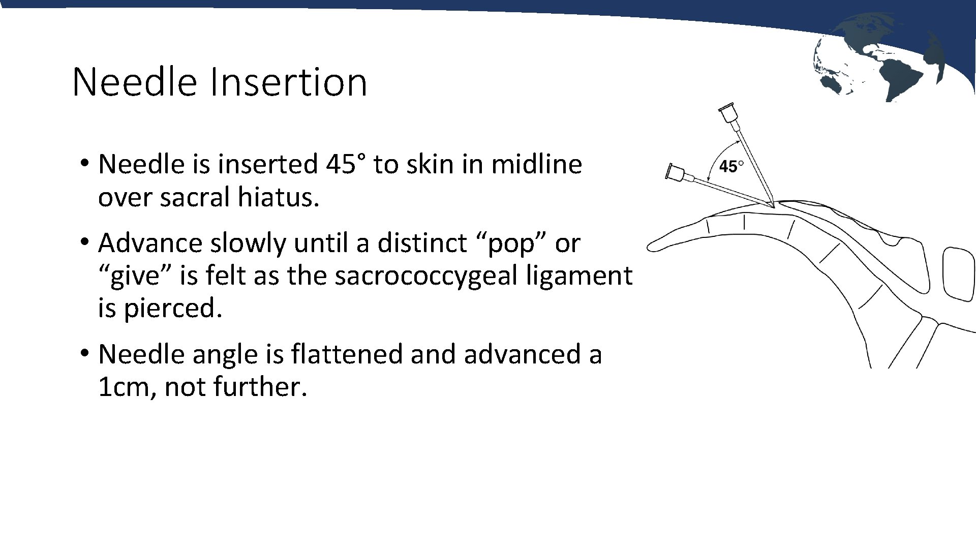 Needle Insertion • Needle is inserted 45° to skin in midline over sacral hiatus.