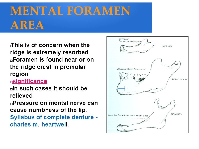 MENTAL FORAMEN AREA This is of concern when the ridge is extremely resorbed �