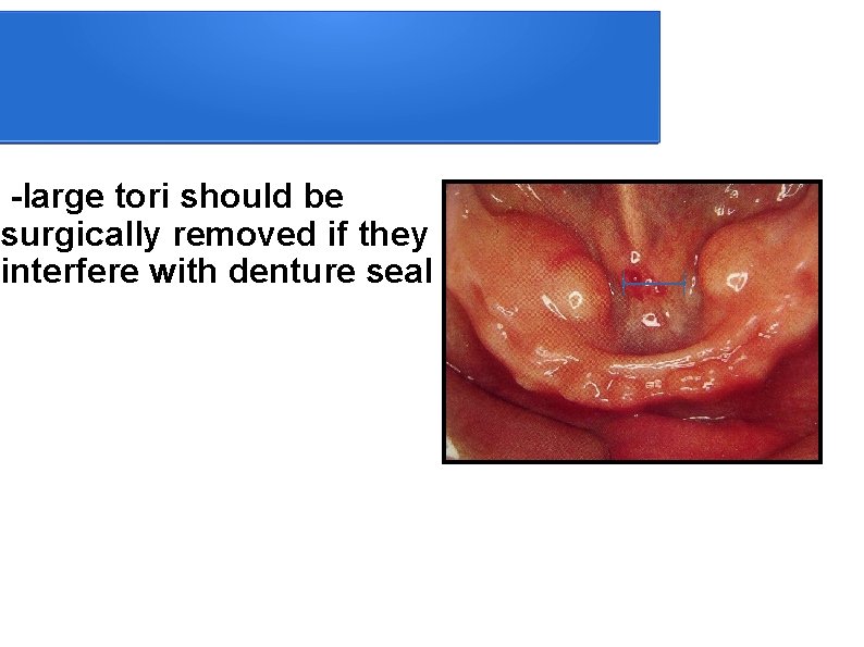  -large tori should be surgically removed if they interfere with denture seal 