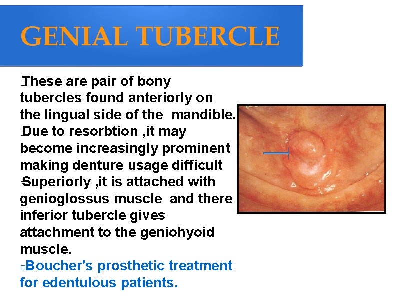 GENIAL TUBERCLE These are pair of bony tubercles found anteriorly on the lingual side