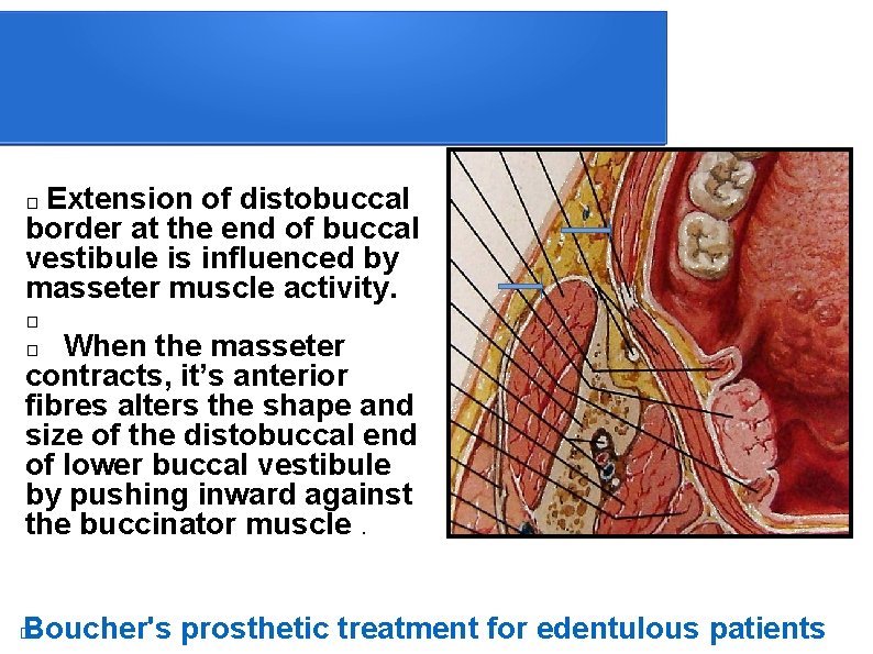  Extension of distobuccal border at the end of buccal vestibule is influenced by