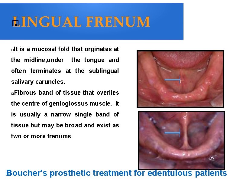 . LINGUAL FRENUM � It is a mucosal fold that orginates at � the