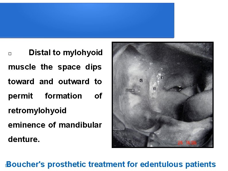 � Distal to mylohyoid muscle the space dips toward and outward to permit formation