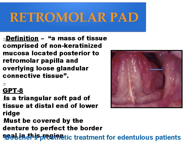 RETROMOLAR PAD Definition – “a mass of tissue comprised of non-keratinized mucosa located posterior