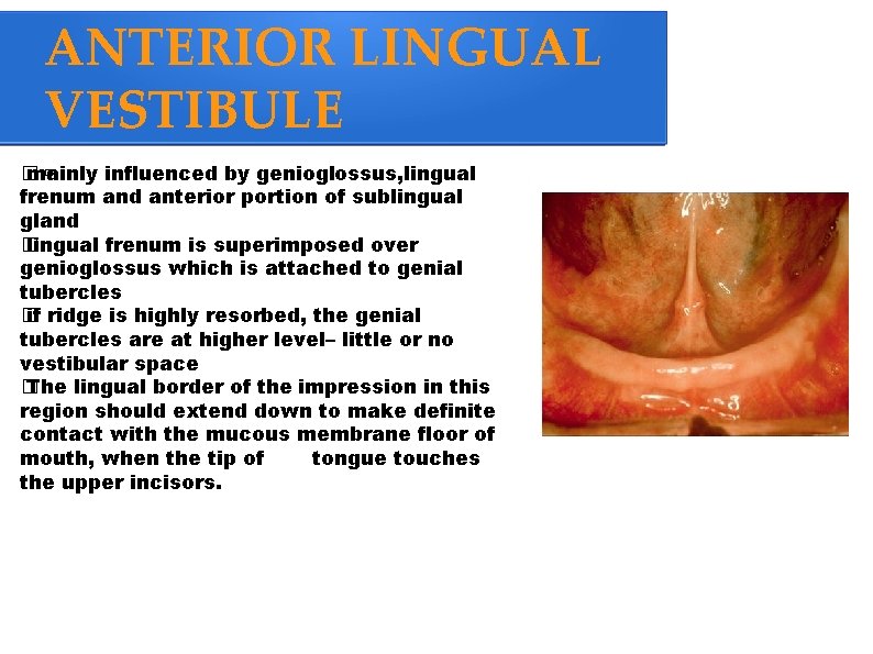 ANTERIOR LINGUAL VESTIBULE �. � mainly influenced by genioglossus, lingual frenum and anterior portion
