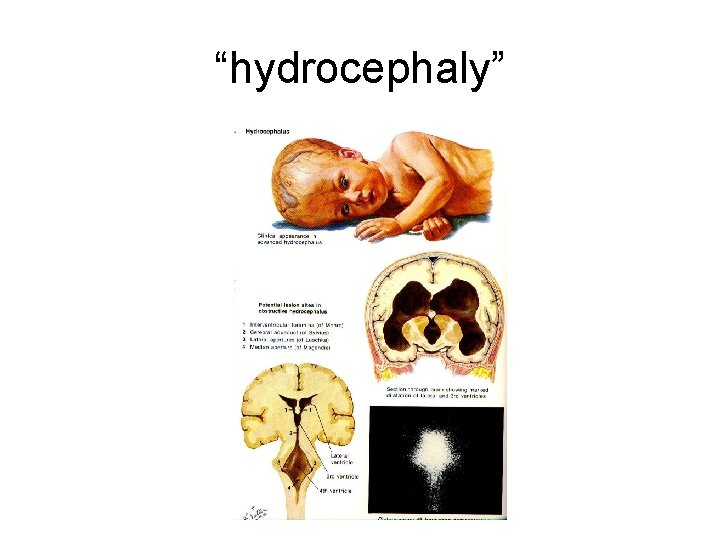 “hydrocephaly” 