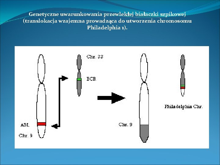 Genetyczne uwarunkowania przewlekłej białaczki szpikowej (translokacja wzajemna prowadząca do utworzenia chromosomu Philadelphia 1). 