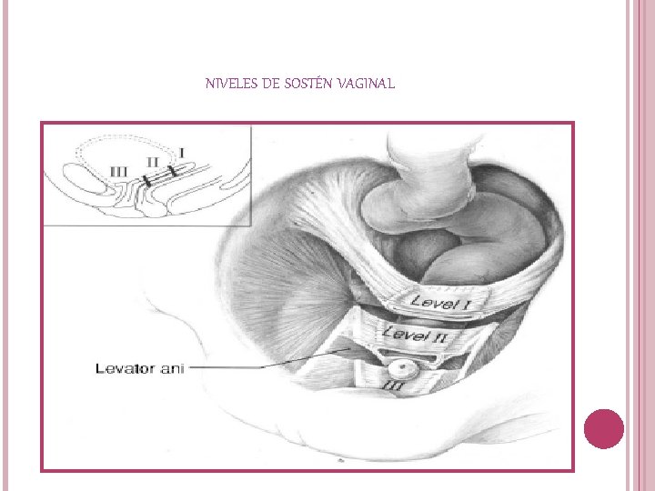 NIVELES DE SOSTÉN VAGINAL 