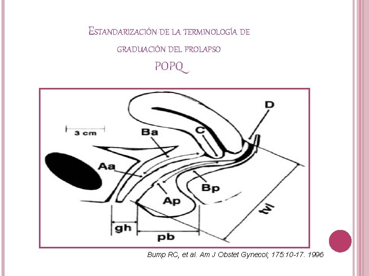 ESTANDARIZACIÓN DE LA TERMINOLOGÍA DE GRADUACIÓN DEL PROLAPSO POPQ Bump RC, et al. Am