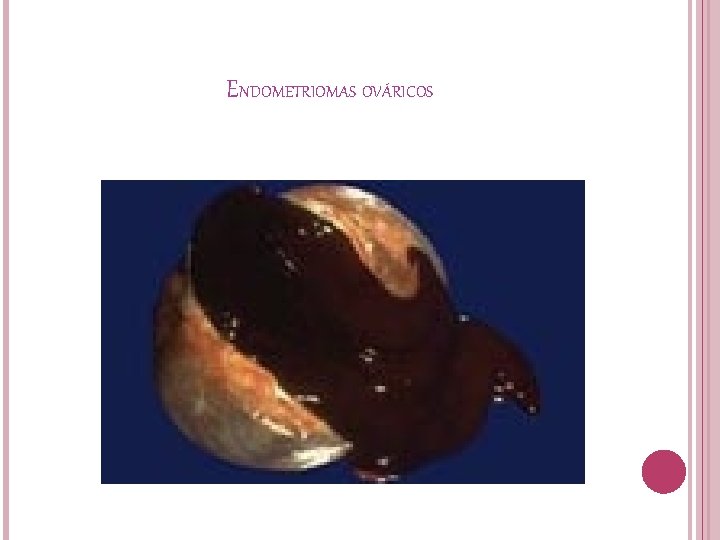 ENDOMETRIOMAS OVÁRICOS 