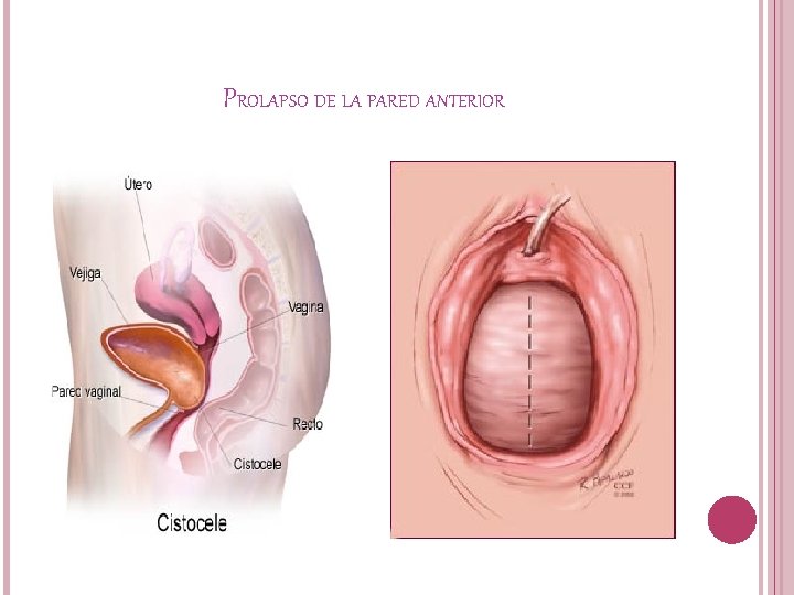 PROLAPSO DE LA PARED ANTERIOR 