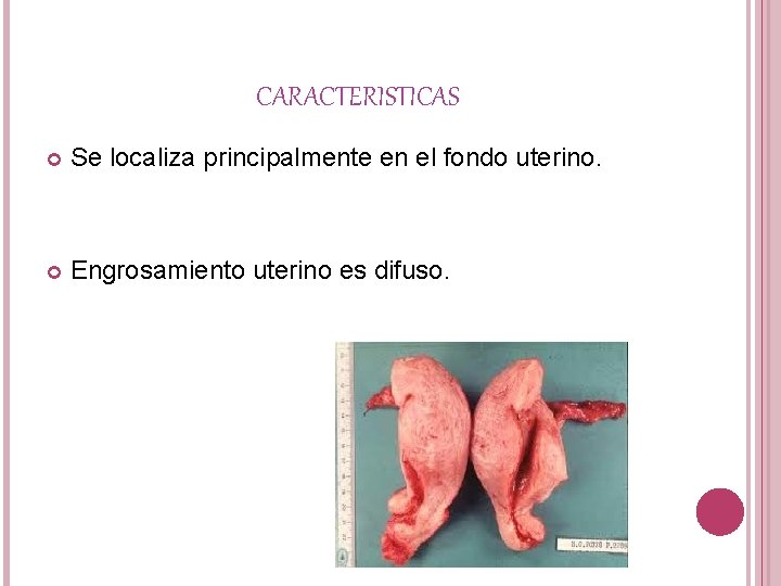CARACTERISTICAS Se localiza principalmente en el fondo uterino. Engrosamiento uterino es difuso. 