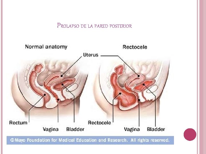 PROLAPSO DE LA PARED POSTERIOR 