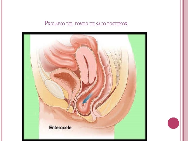 PROLAPSO DEL FONDO DE SACO POSTERIOR 