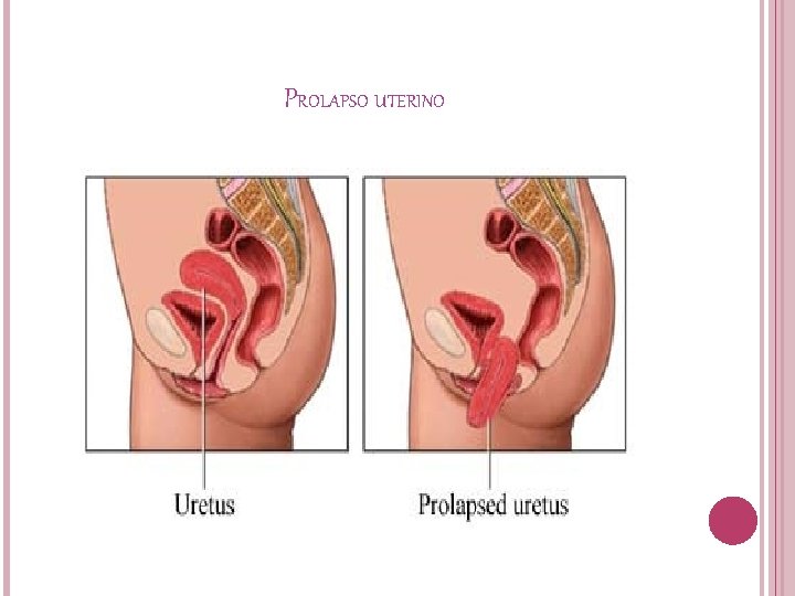 PROLAPSO UTERINO 