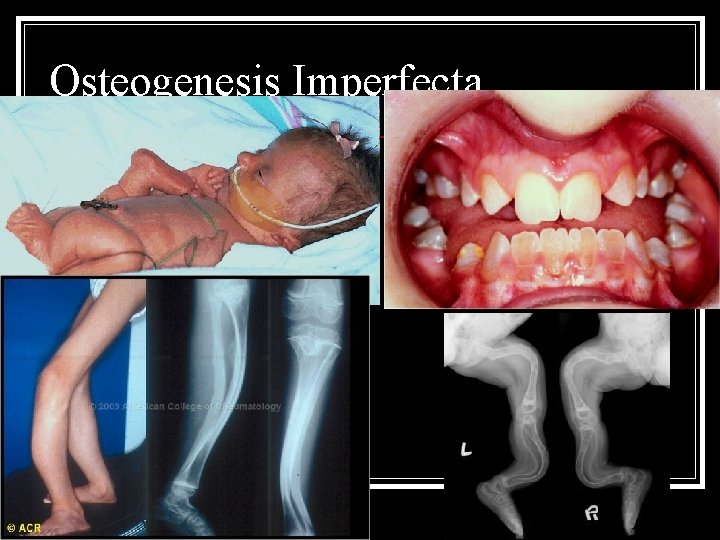 Osteogenesis Imperfecta 