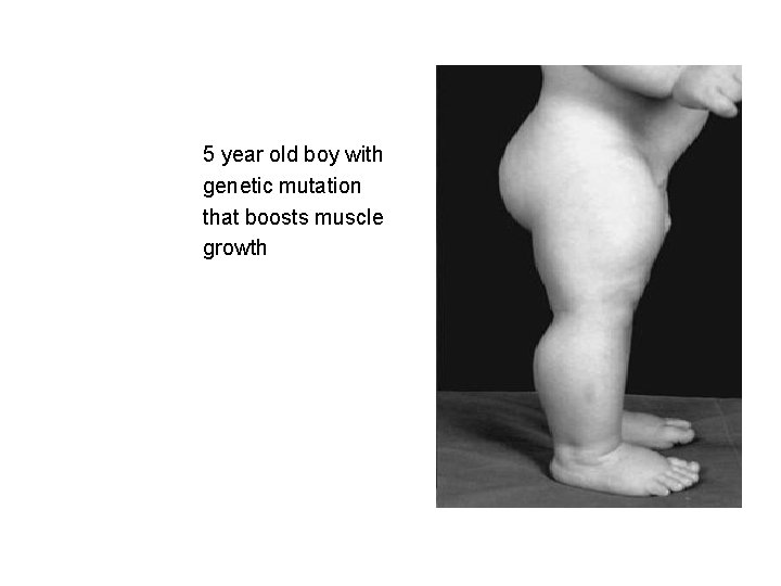 5 year old boy with genetic mutation that boosts muscle growth 
