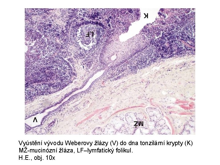 Vyústění vývodu Weberovy žlázy (V) do dna tonzilární krypty (K) MŽ-mucinózní žláza, LF–lymfatický folikul.