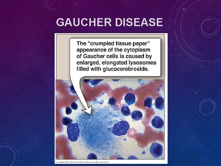 GAUCHER DISEASE GAUCHER DISEASE