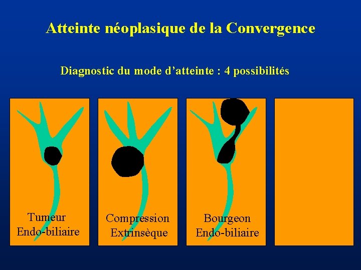 Atteinte néoplasique de la Convergence Diagnostic du mode d’atteinte : 4 possibilités Tumeur Endo-biliaire
