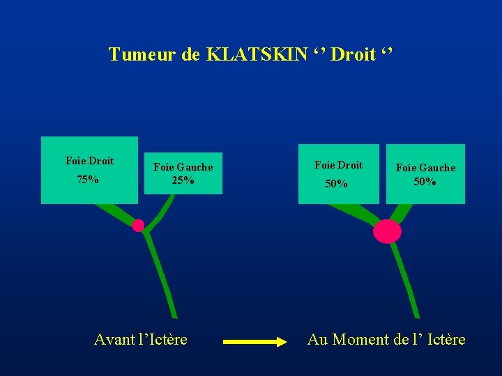Tumeur de KLATSKIN ‘’ Droit ‘’ Foie Droit 75% Foie Gauche 25% Avant l’Ictère