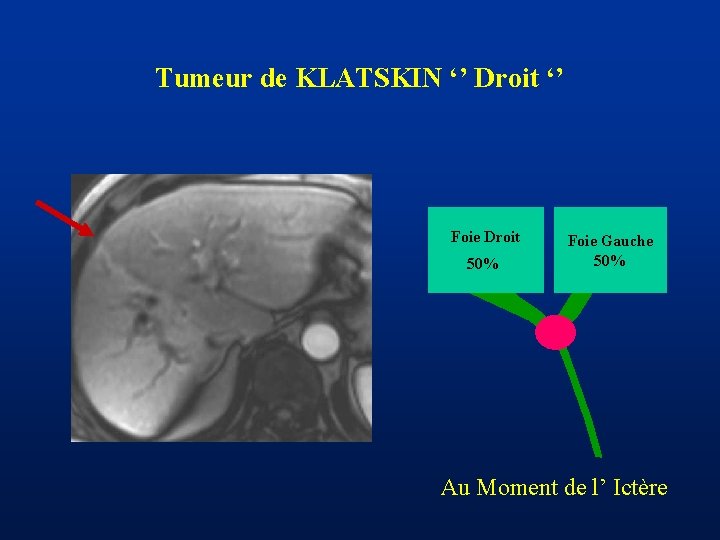 Tumeur de KLATSKIN ‘’ Droit ‘’ Foie Droit 50% Foie Gauche 50% Au Moment