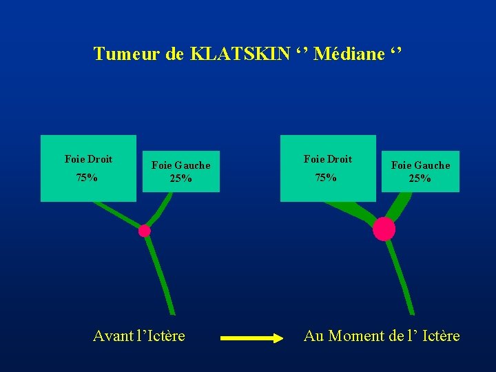 Tumeur de KLATSKIN ‘’ Médiane ‘’ Foie Droit 75% Foie Gauche 25% Avant l’Ictère