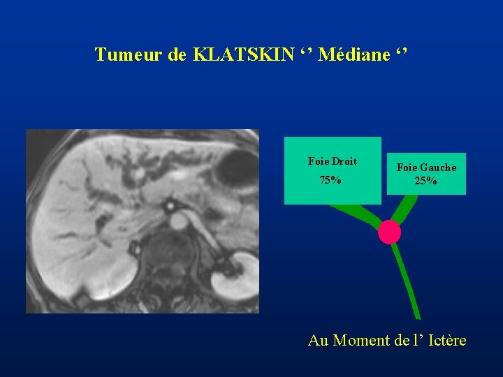 Tumeur de KLATSKIN ‘’ Médiane ‘’ Foie Droit 75% Foie Gauche 25% Au Moment