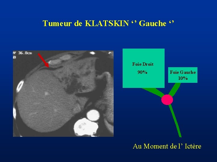 Tumeur de KLATSKIN ‘’ Gauche ‘’ Foie Droit 90% Foie Gauche 10% Au Moment