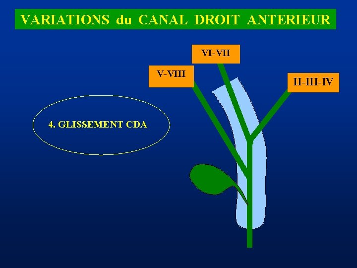 VARIATIONS du CANAL DROIT ANTERIEUR VI-VII V-VIII 4. GLISSEMENT CDA II-IV 