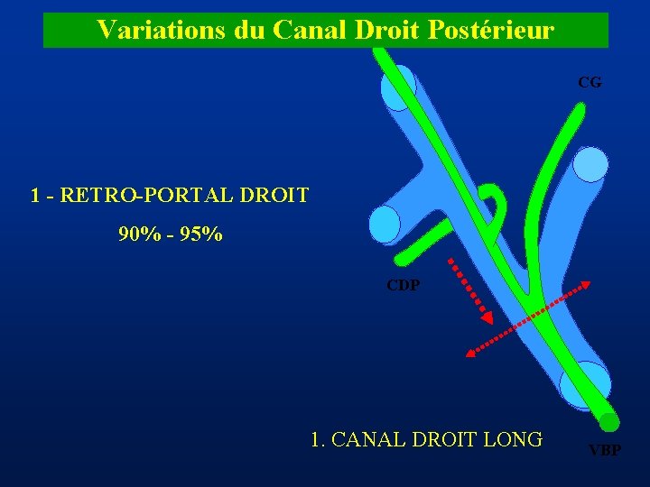 Variations du Canal Droit Postérieur CDA CG 1 - RETRO-PORTAL DROIT 90% - 95%